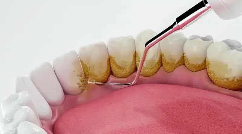 Dental Scaling