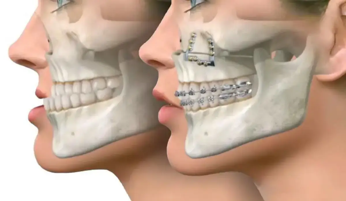 انواع استئوتومی فک