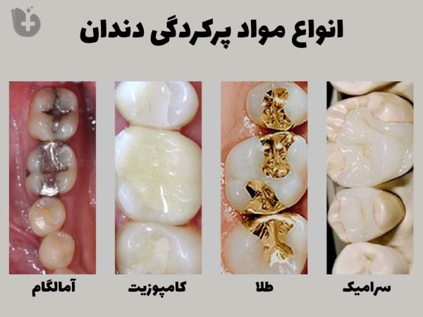 انواع مواد پرکردگی دندان