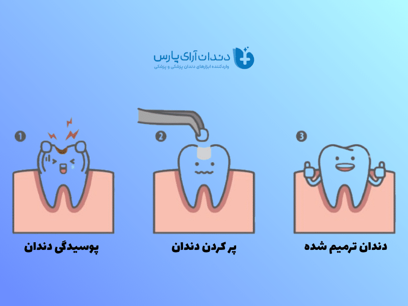 مراحل پر کردن دندان